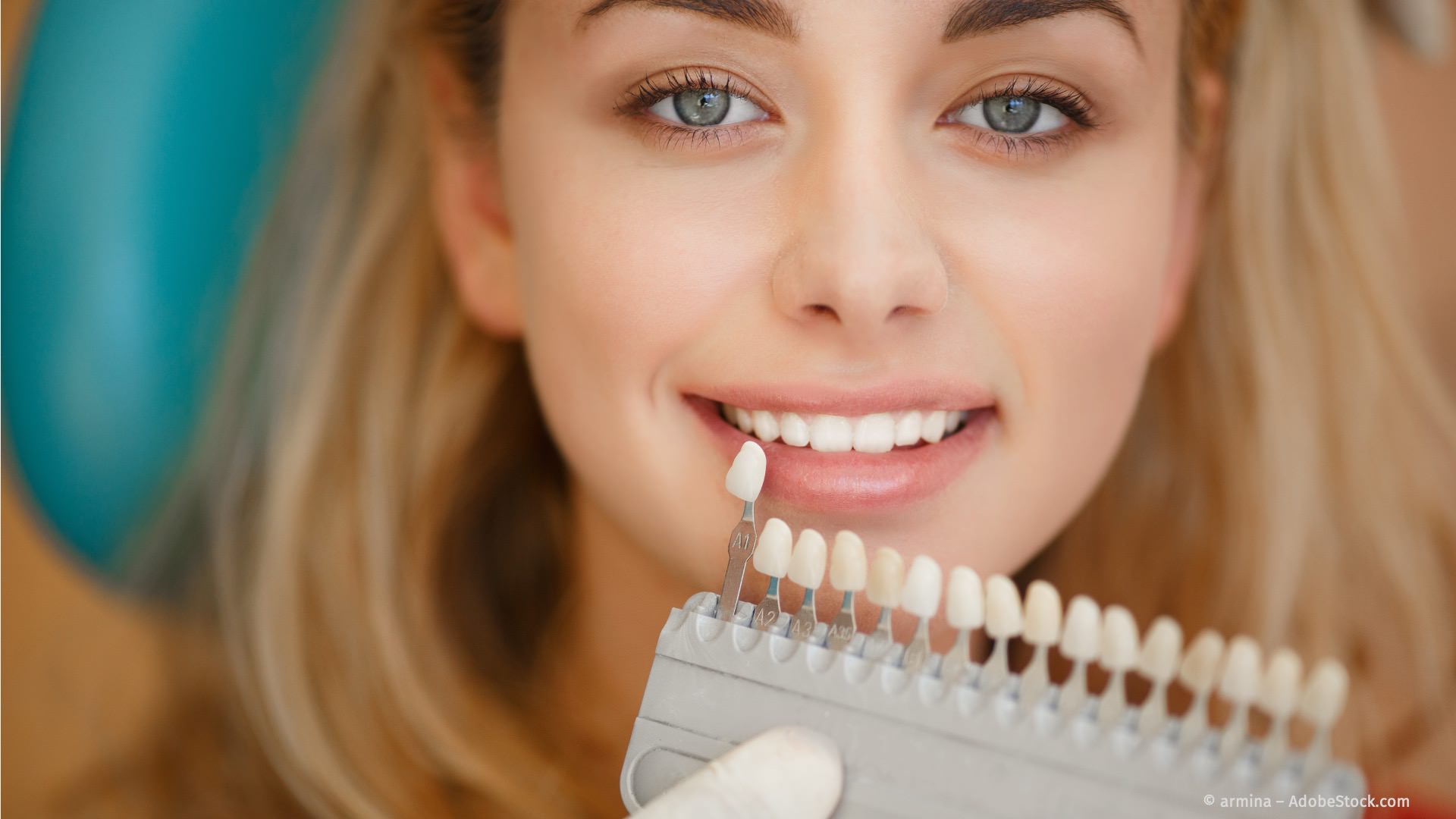 Bleaching: weiße Zähne mit Zahnaufhellung