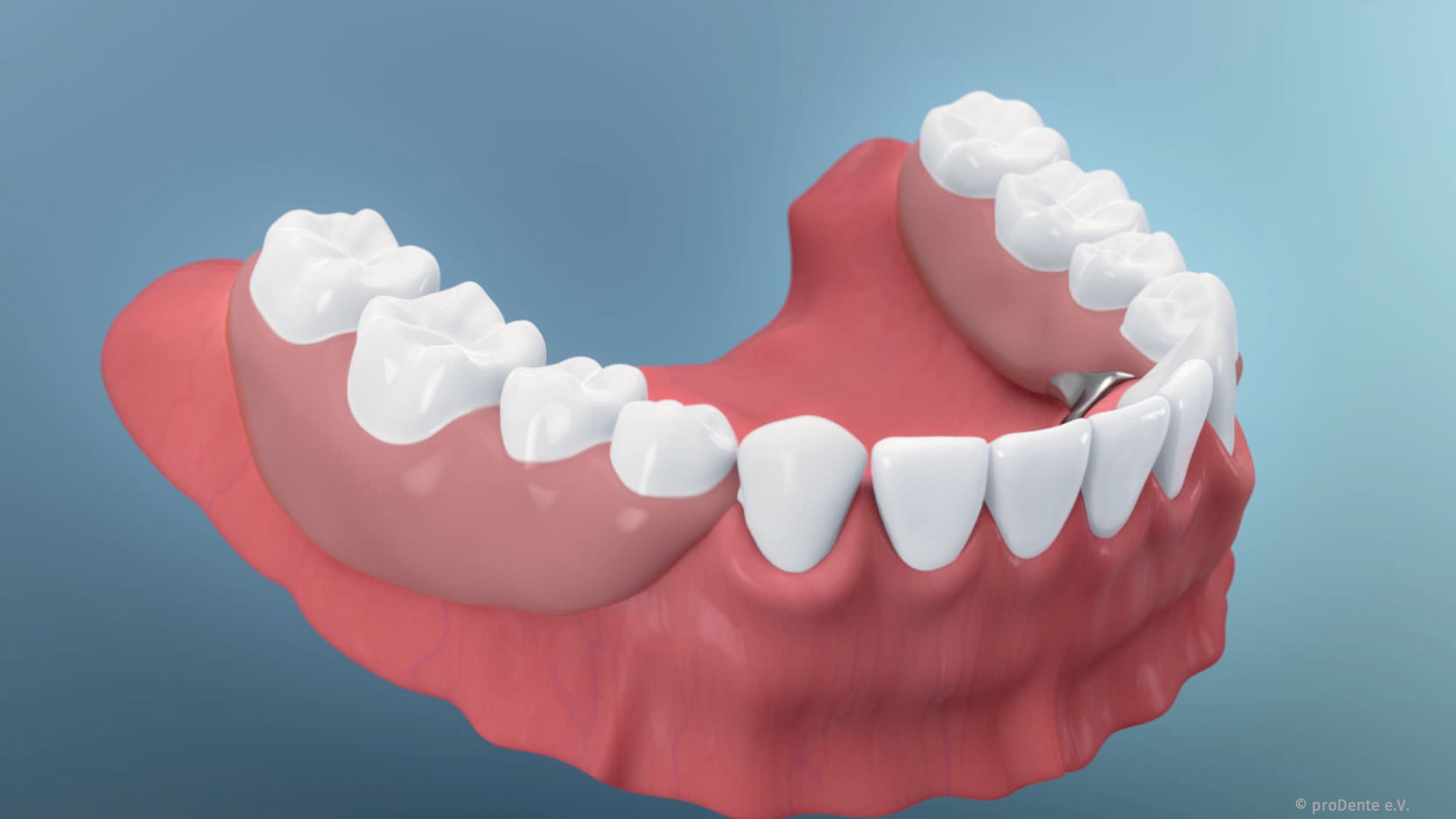 Herausnehmbarer Zahnersatz: Teilprothesen und Vollprothesen