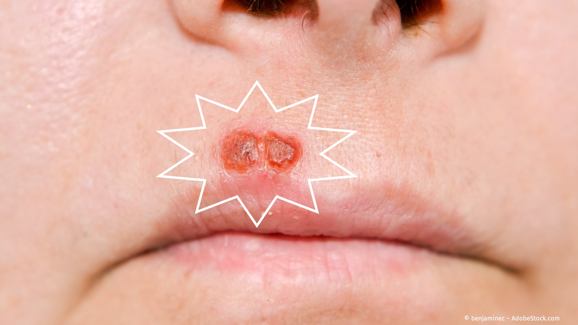 Laserlicht gegen Lippen-Herpes und Aphthen