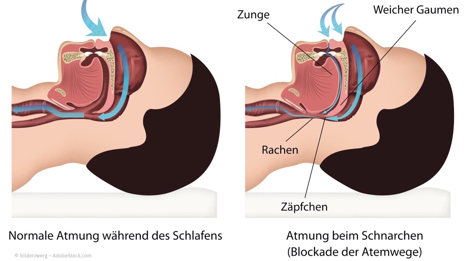 Ursache für das Schnarchen